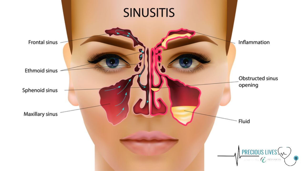 Online Doctor for Sinus Infection in New York